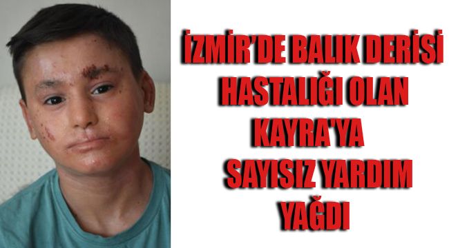 İZMİR’DE BALIK DERİSİ HASTALIĞI OLAN KAYRA'YA SAYISIZ YARDIM YAĞDI