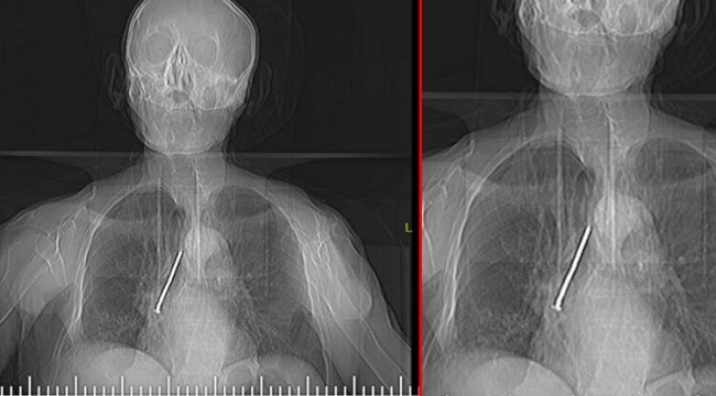 Nefes darlığı şikayetiyle gitti, hastanede şoke oldu