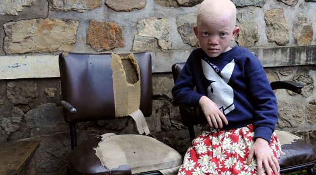 Zambiya’da albino çocuğun eli "büyü" için kesildi
