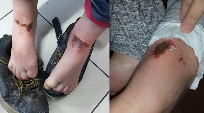 Kar topu oynarken yanmışlardı, olayı anlattı