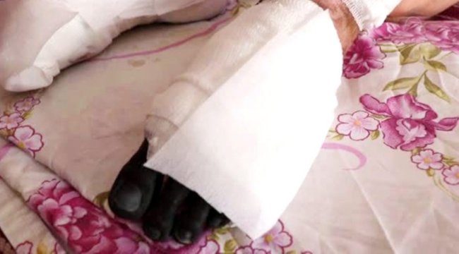 Bacağındaki genetik rahatsızlık nedeniyle eve hapsoldu