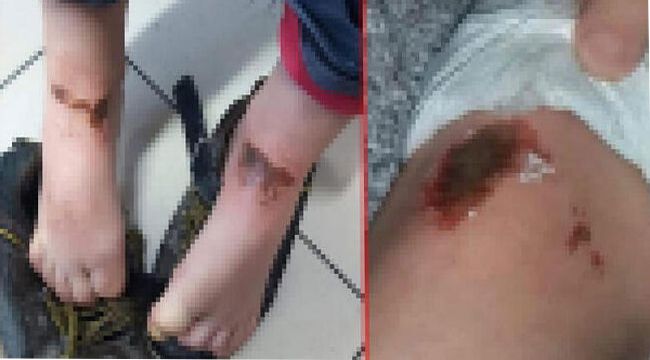 Çocukların yanıklarının nedeni belli oldu