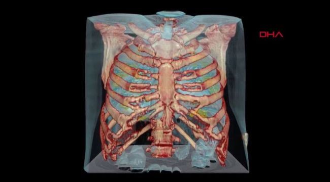 Koronavirüslü akciğerin 3D görüntüsü paylaşıldı