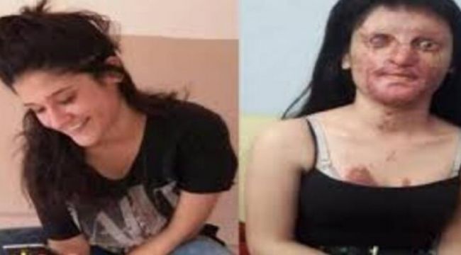 Yüzünü asitle yakan eski sevgilisini affeden Berfin'in ailesi harekete geçti