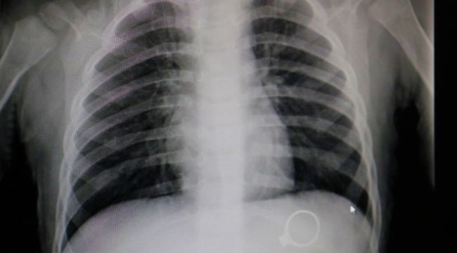 Annesinin 3 bin liralık tek taş yüzüğünü yuttu