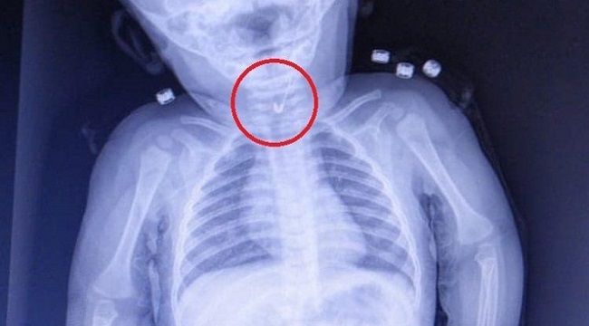 Bebeğin yemek borusunda çengelli iğne bulundu