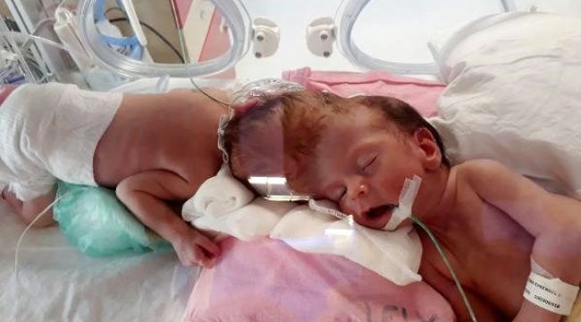 Antalyalı siyam ikizleri, İngiltere'de ameliyat oldu