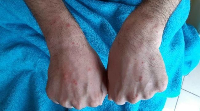 Cerrahpaşa'da koronavirüs hastalarının deri bulguları incelendi