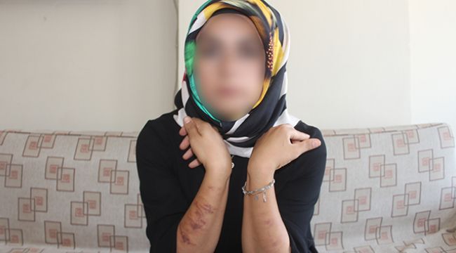 Lazer genç kadının vücudunu yaktı