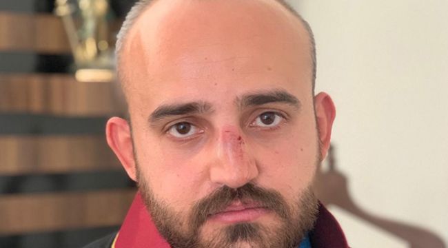 Avukatın burnunu kırdılar