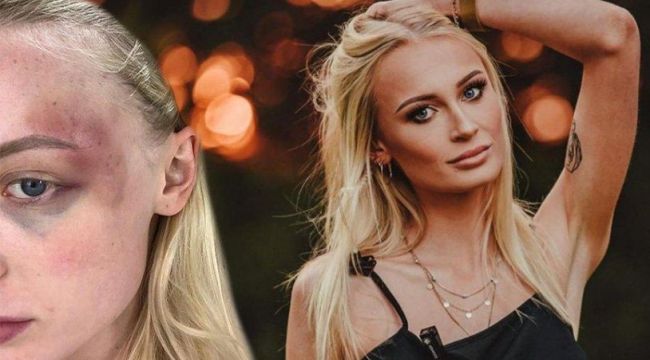 Ünlü model şiddeti fotoğraflarla belgeledi