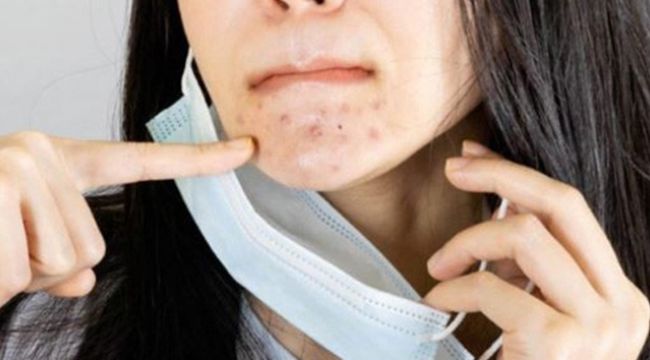 Maske sonrası artan cilt problemlerine çözüm  su