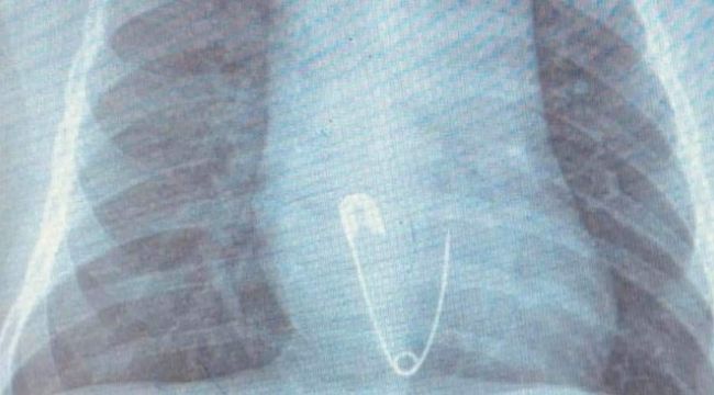 5 aylık bebeğin yuttuğu çengelli iğne operasyonla çıkarıldı