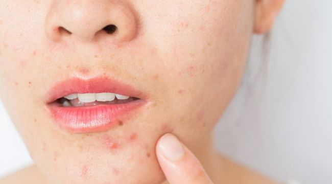 Maske sivilcesine dikkat
