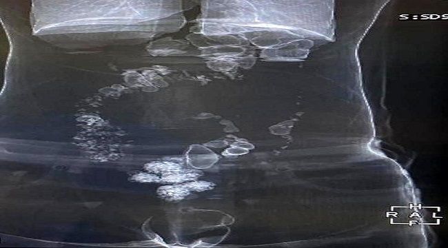 Mide ve bağırsaklardan uyuşturucu çıktı