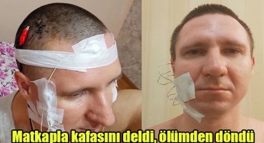 Matkapla kafasını deldi, ölümden döndü