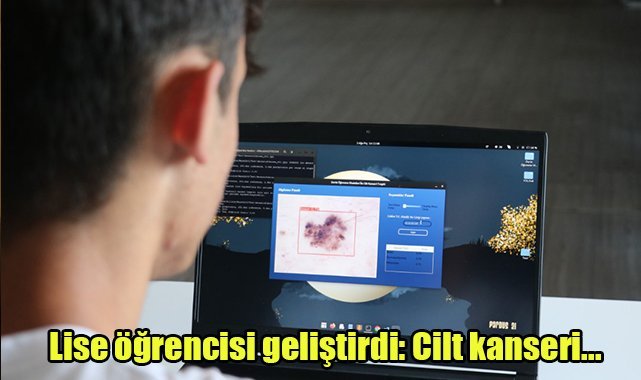 Lise öğrencisi geliştirdi:Cilt kanseri...