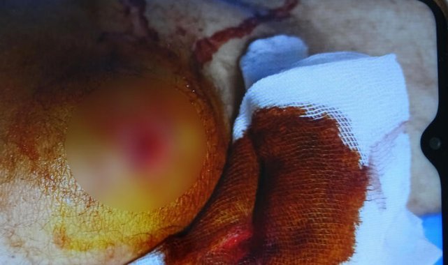 Ot biçtiği yaylada dinlenirken yorgun mermi ile yaralandı