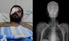Pusu kuran hasımları av tüfeğiyle vurdu, bir gözünü kaybetti