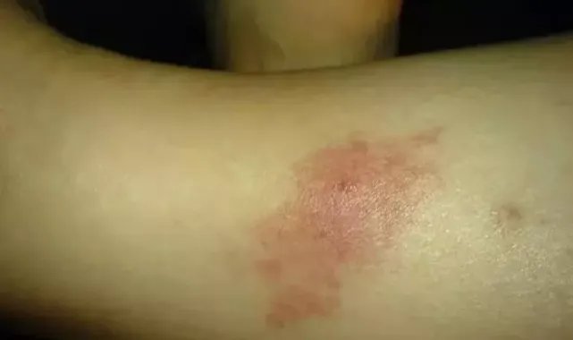 Küresel ısınmayla vektörel hastalıklar tehlikesi