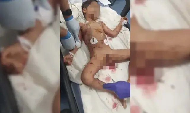 Sokak köpeklerinin saldırısına uğrayan çocuk ağır yaralandı