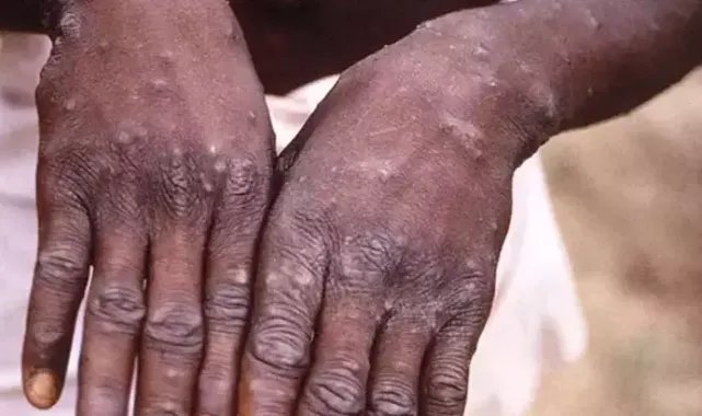 'Ankara'da MPox karantinası' iddialarına yalanlama