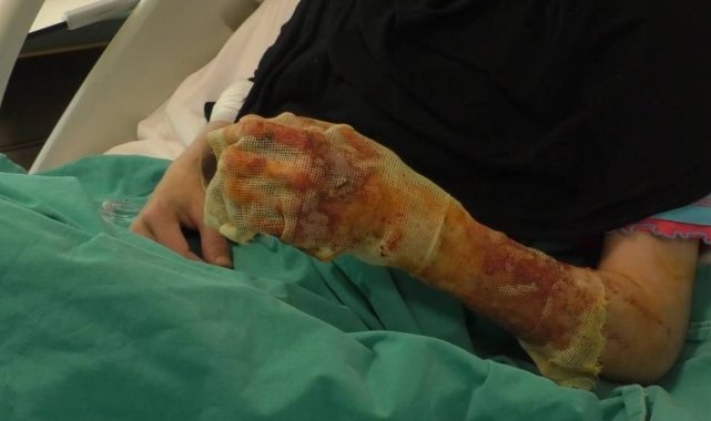 Mangal ateşine dezenfektan döken çift dehşeti yaşadı