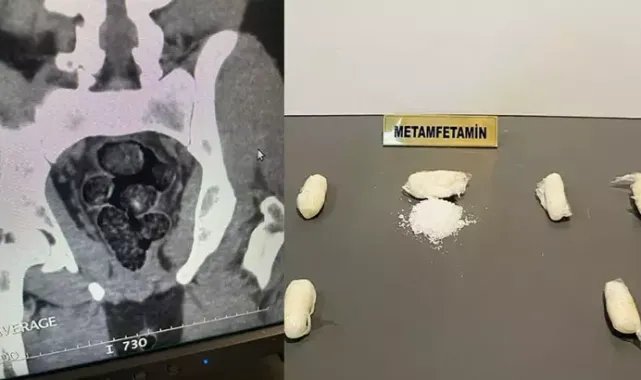 Midesinde uyuşturucu taşıyan İranlı, havalimanında yakalandı