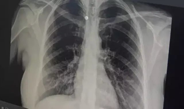 Prof. Dr. Özlü'den 'akut bronşit' uyarısı
