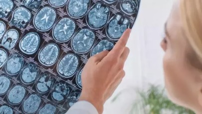 İngiltere'de beyin kanaması geçiren bir kişi, kafatası parçasını midesinde taşıdı