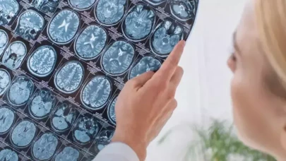 İngiltere'de beyin kanaması geçiren bir kişi, kafatası parçasını midesinde taşıdı