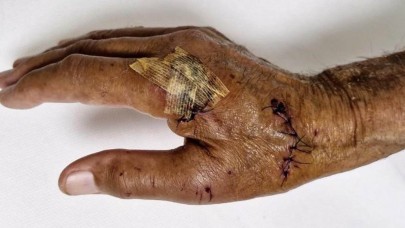 Duşa kabin patladı, eline 20’ye yakın dikiş atıldı