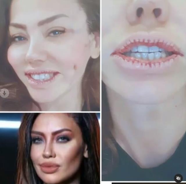 Lara, dudaklarını küçülttü