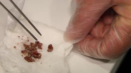 Elazığ’da estetik ameliyatta şaşırtan olay, burundan taş çıktı