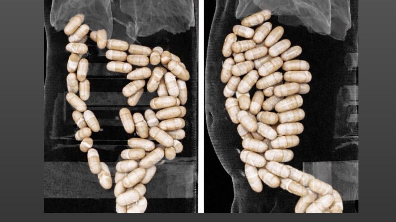 Midesinde uyuşturucu taşıyan şüpheliler tutuklandı